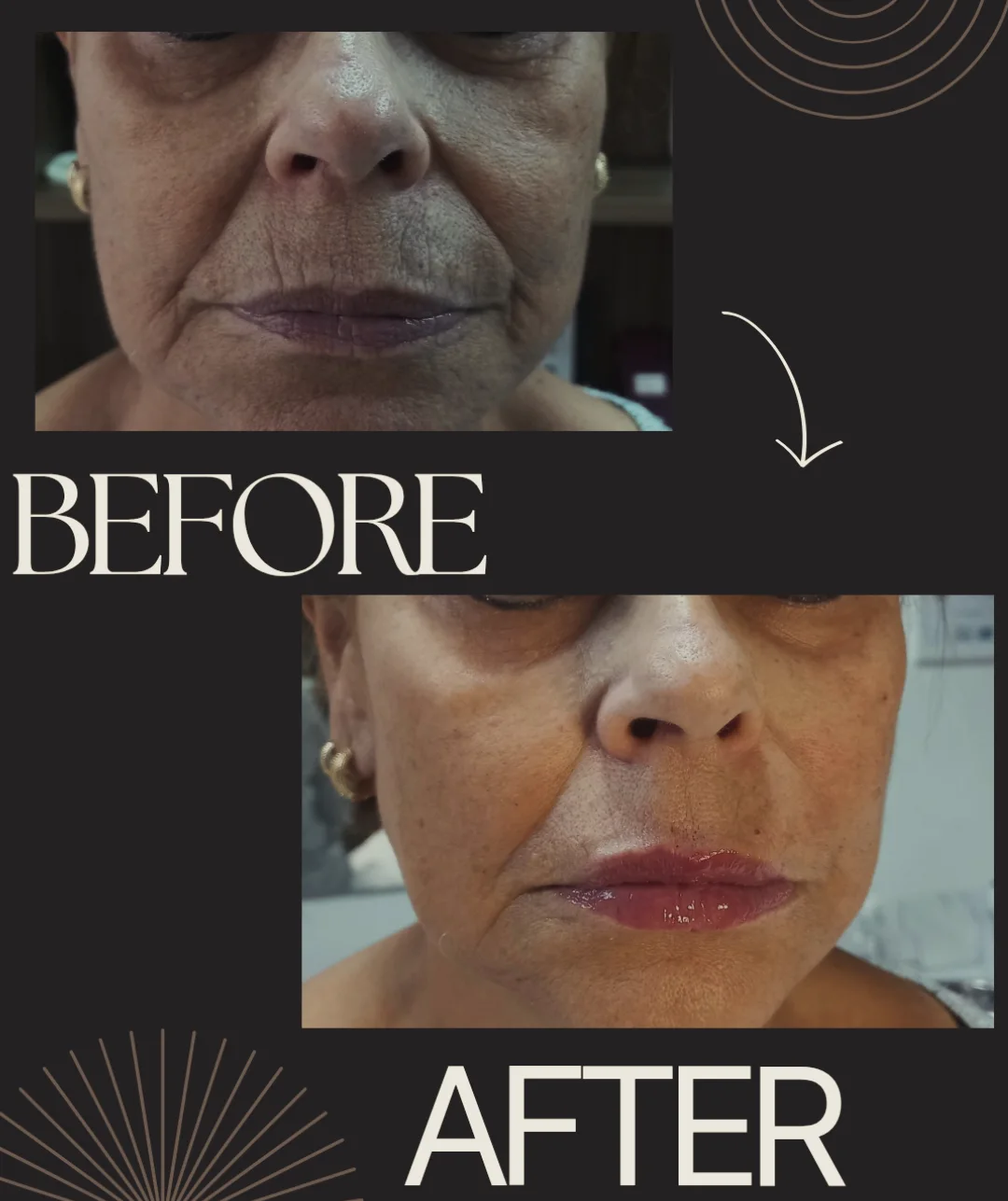 Antes e Depois - Colágeno