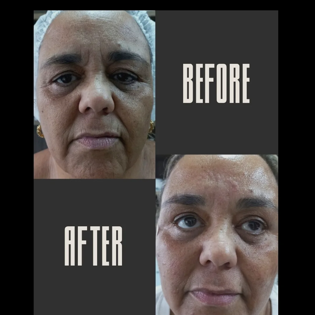 Antes e Depois - Harmonização